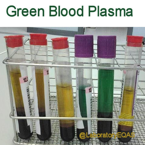 Blood Plasma Plasma Color Chart