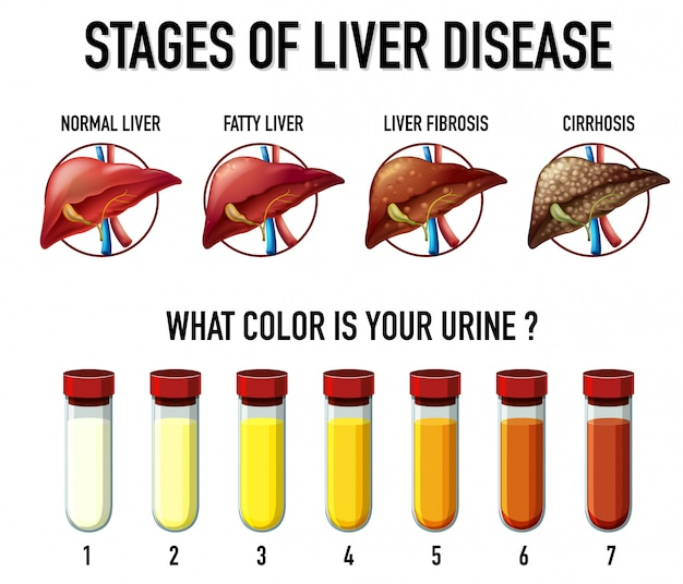 Liver Damage Urine Color Infoupdate