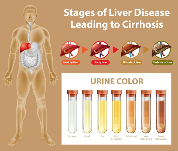 Liver Damage Urine Color Infoupdate