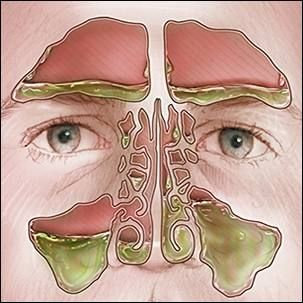 Nose Mucus Color Chart Vrogue co