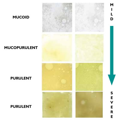 Phlegm Color Chart Truecfiles What Does The Color Of Phlegm Mean Ohio 
